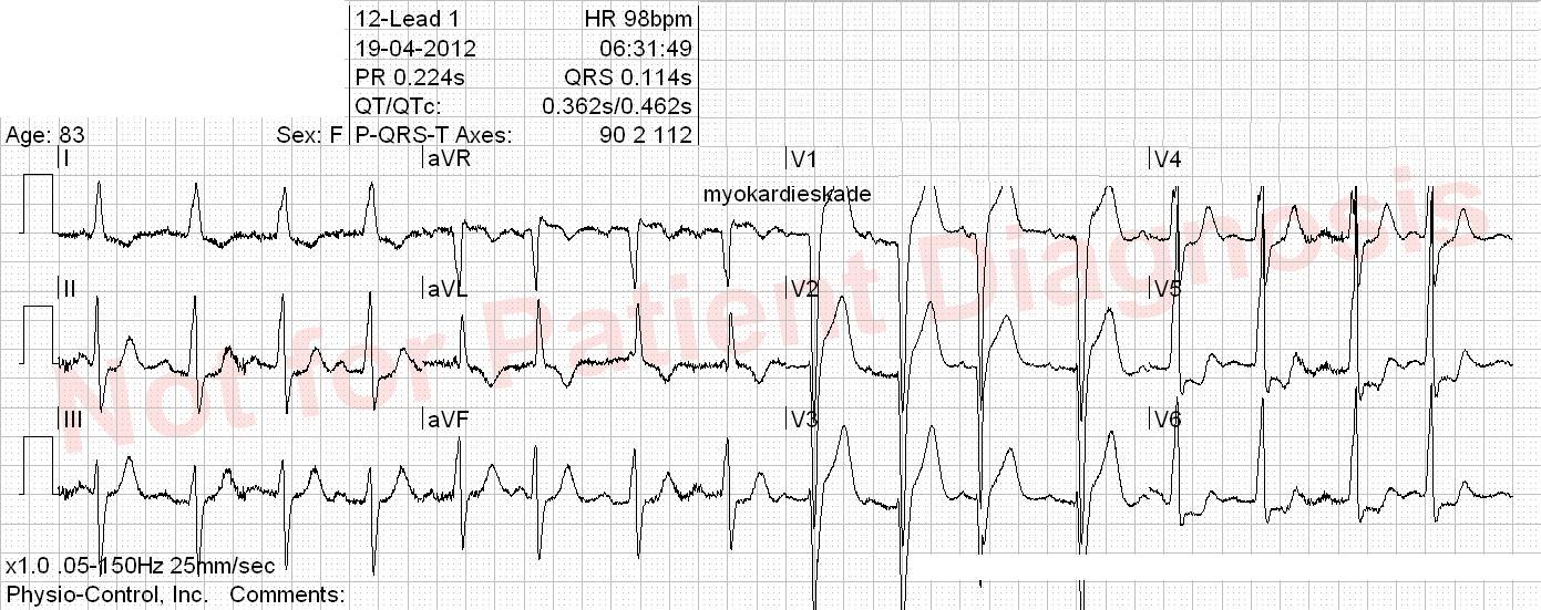 Left ventricular hypertrophy ECG
